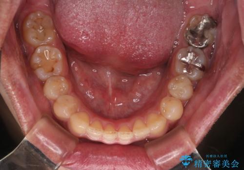 【モニター】インビザライン 前歯の捻れを治したいの治療後