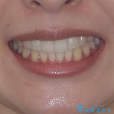 前歯のデコボコを治したい インビザライン矯正の治療後(顔貌)
