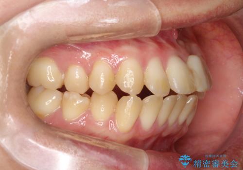 前歯の開咬とシザーズバイトを改善|インビザライン矯正の治療前