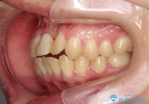 前歯の開咬とシザーズバイトを改善|インビザライン矯正の治療前