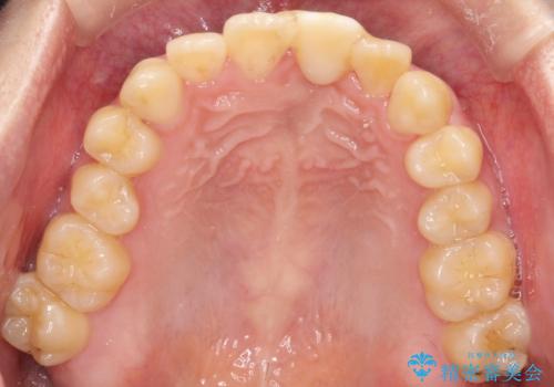 前歯の開咬とシザーズバイトを改善|インビザライン矯正の治療前
