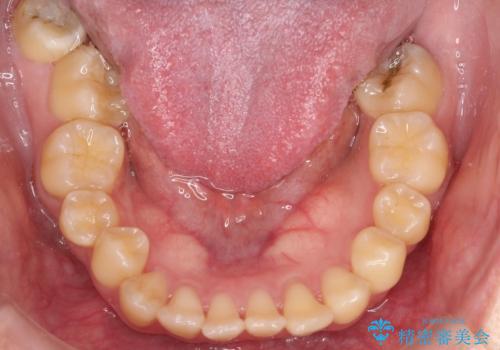 前歯の開咬とシザーズバイトを改善|インビザライン矯正の治療前