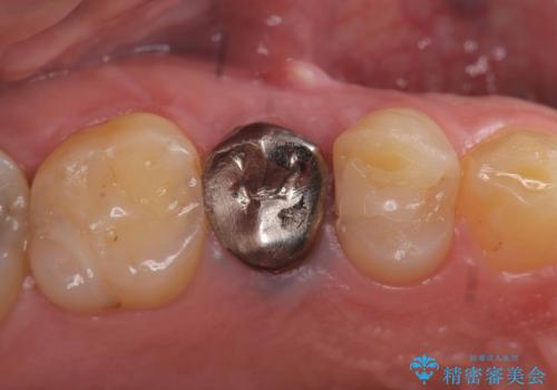 低侵襲なインプラント|痛くないインプラント|エンドペリオ病変|虫歯治療|セラッミクインレーの症例 治療前