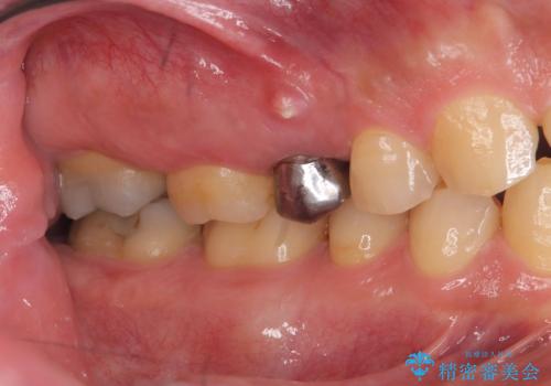 低侵襲なインプラント|痛くないインプラント|エンドペリオ病変|虫歯治療|セラッミクインレーの治療前