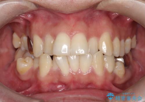 重度の叢生を抜歯矯正で改善|審美ワイヤー矯正+海外出張に伴う中断・再開対応