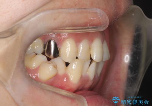 重度の叢生を抜歯矯正で改善|審美ワイヤー矯正+海外出張に伴う中断・再開対応の治療前