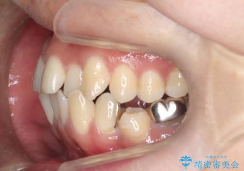 重度の叢生を抜歯矯正で改善|審美ワイヤー矯正+海外出張に伴う中断・再開対応の治療前