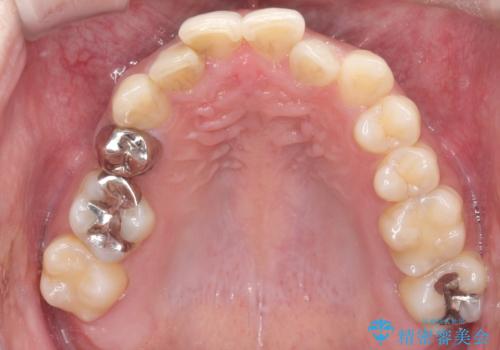 重度の叢生を抜歯矯正で改善|審美ワイヤー矯正+海外出張に伴う中断・再開対応の治療前