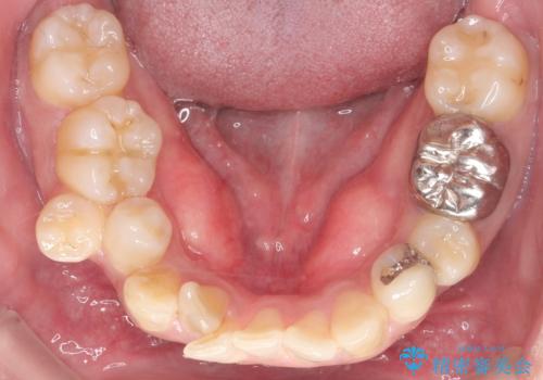 重度の叢生を抜歯矯正で改善|審美ワイヤー矯正+海外出張に伴う中断・再開対応の治療前