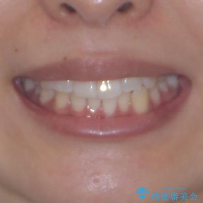 前歯のデコボコを治したい インビザライン矯正の治療前(顔貌)