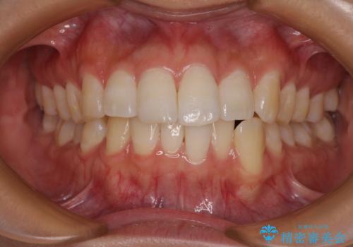 前歯のデコボコを治したい インビザライン矯正の症例 治療前