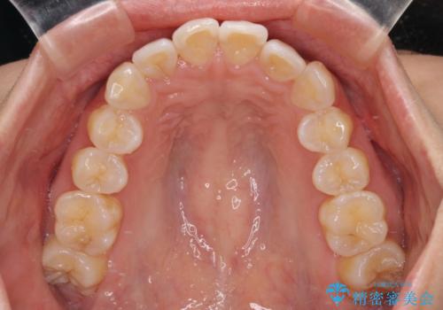 前歯のデコボコを治したい　インビザライン矯正の治療前