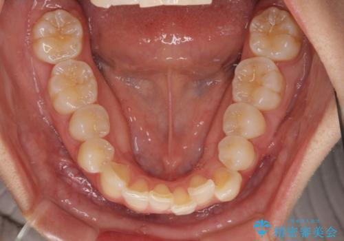 前歯のデコボコを治したい　インビザライン矯正の治療前