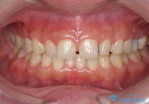 ホワイトニングで歯を白くの治療前