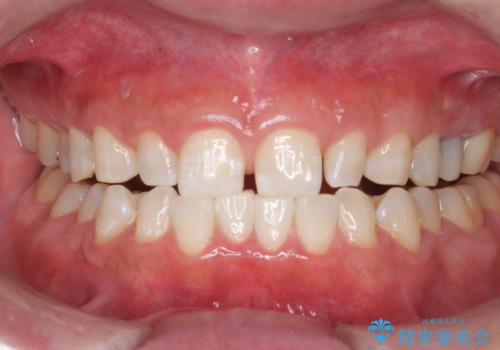 ホワイトニングで歯を白くの治療後