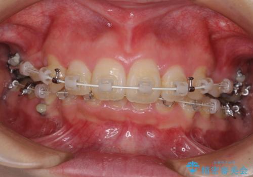 飛び出した前歯 抜歯矯正で横顔が劇的変化の治療中
