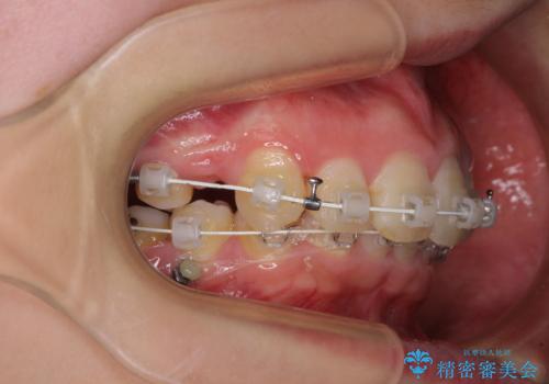 飛び出した前歯 抜歯矯正で横顔が劇的変化の治療中