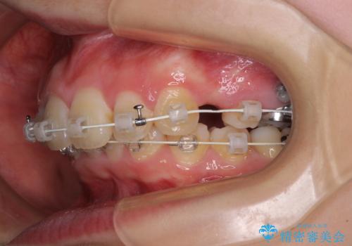飛び出した前歯 抜歯矯正で横顔が劇的変化の治療中