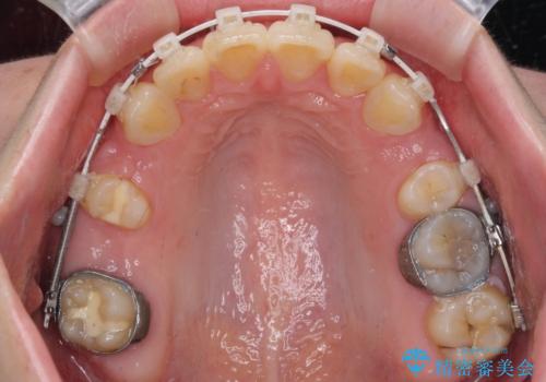飛び出した前歯 抜歯矯正で横顔が劇的変化の治療中