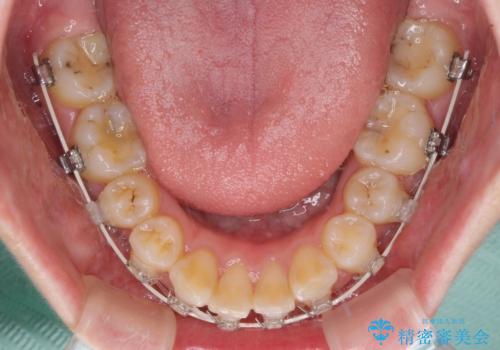 飛び出した前歯　抜歯矯正で横顔が劇的変化の治療中