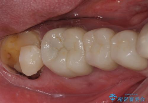 破折した奥歯 1DAYインプラントで短期間治療の症例 治療前