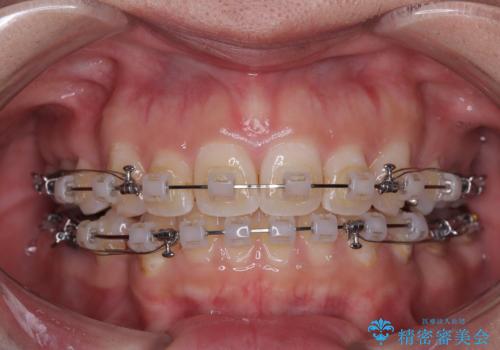 出っ歯と奥歯のむし歯 ワイヤー装置での抜歯矯正とセラミック治療の治療中