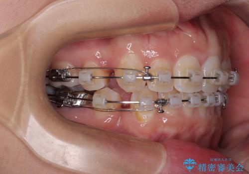 出っ歯と奥歯のむし歯 ワイヤー装置での抜歯矯正とセラミック治療の治療中