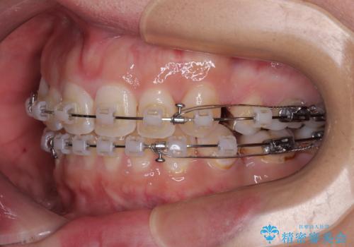 出っ歯と奥歯のむし歯 ワイヤー装置での抜歯矯正とセラミック治療の治療中