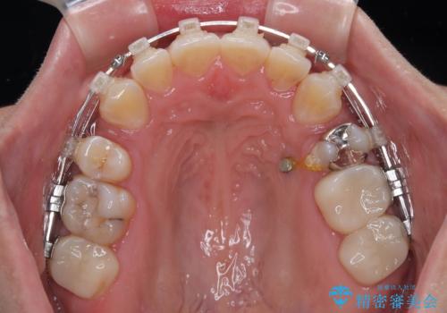 出っ歯と奥歯のむし歯 ワイヤー装置での抜歯矯正とセラミック治療の治療中