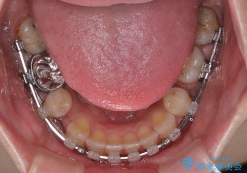 出っ歯と奥歯のむし歯 ワイヤー装置での抜歯矯正とセラミック治療の治療中