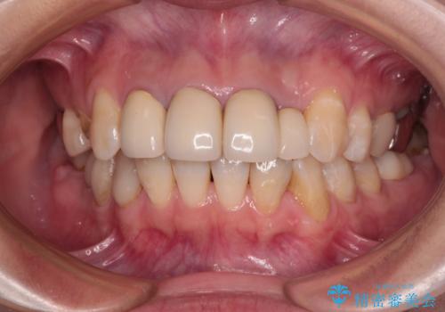 以前の治療箇所が痛む 全顎的なむし歯治療