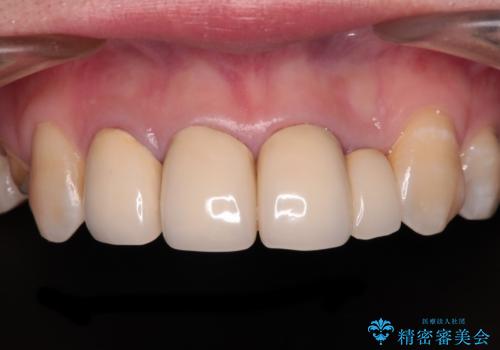 以前の治療箇所が痛む 全顎的なむし歯治療の症例 治療前