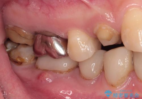 以前の治療箇所が痛む 全顎的なむし歯治療の治療前
