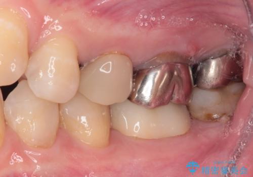 以前の治療箇所が痛む 全顎的なむし歯治療の治療前