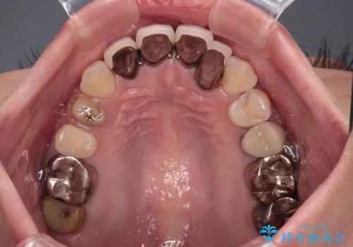 以前の治療箇所が痛む 全顎的なむし歯治療の治療前