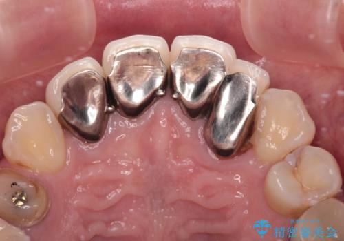 以前の治療箇所が痛む 全顎的なむし歯治療の治療前