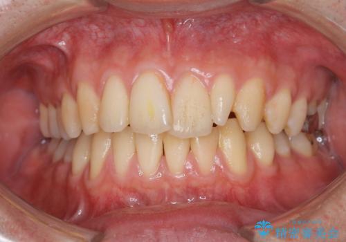 イベント前にエアフローで口元を綺麗にの症例 治療前