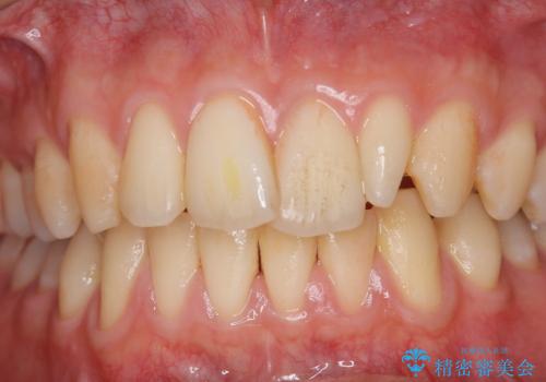 イベント前にエアフローで口元を綺麗にの治療前