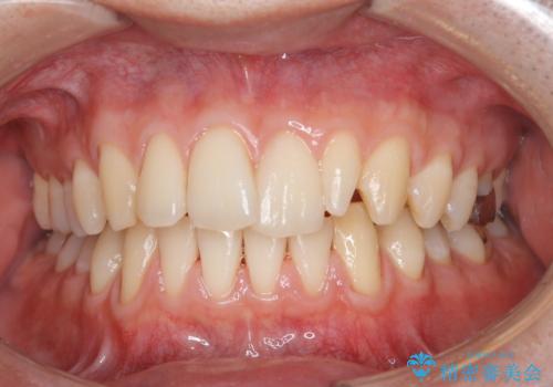 イベント前にエアフローで口元を綺麗にの症例 治療後