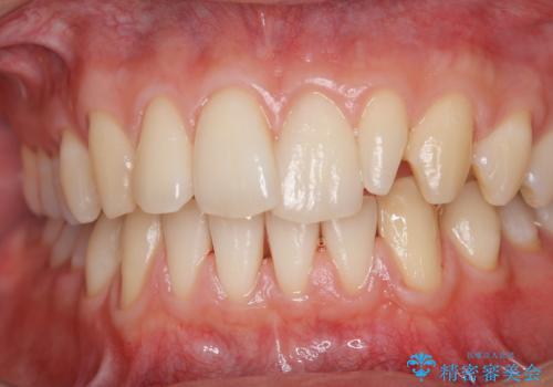 イベント前にエアフローで口元を綺麗にの治療後