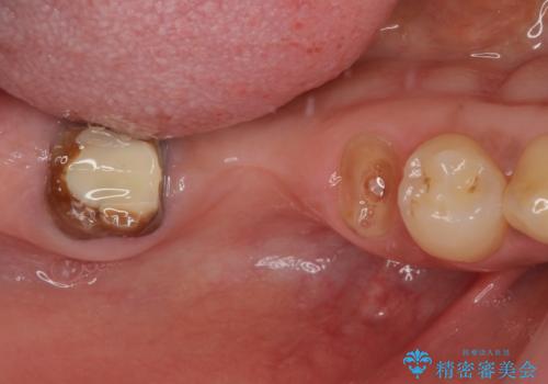 欠損を放置した奥歯 即時荷重インプラントですぐに噛めるようにの症例 治療前