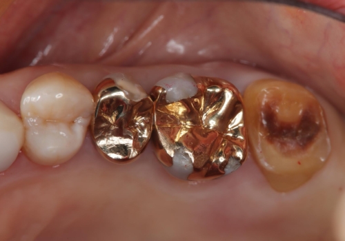 かぶせ物が外れたまま放置 伸びてしまった歯を修復の症例 治療前