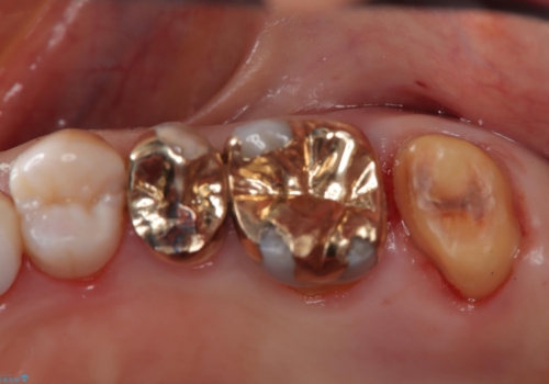 かぶせ物が外れたまま放置 伸びてしまった歯を修復の治療中