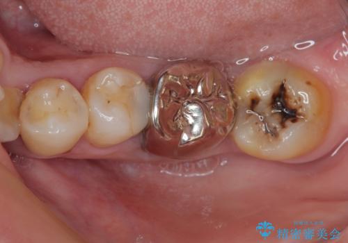 下顎大臼歯の再根管治療とオールセラミッククラウンによる補綴治療の症例 治療前