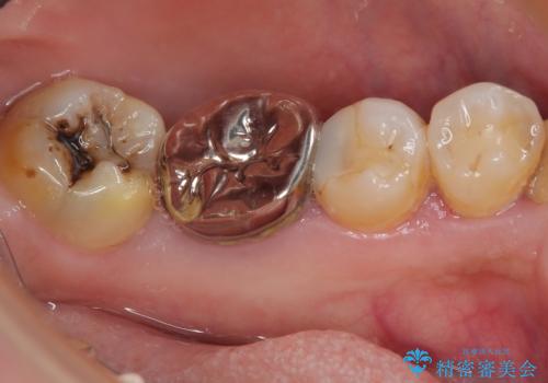 下顎大臼歯の再根管治療とオールセラミッククラウンによる補綴治療の治療前