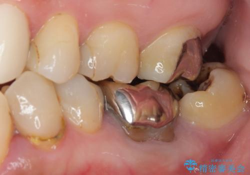 下顎大臼歯の再根管治療とオールセラミッククラウンによる補綴治療の治療前