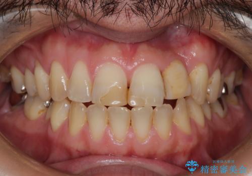 前歯ブリッジの症例 治療前