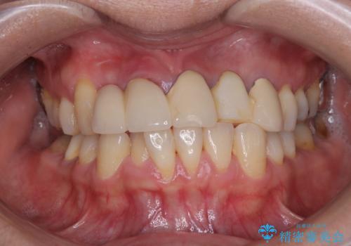 不具合の多い前歯 オールセラミックブリッジ治療の治療前