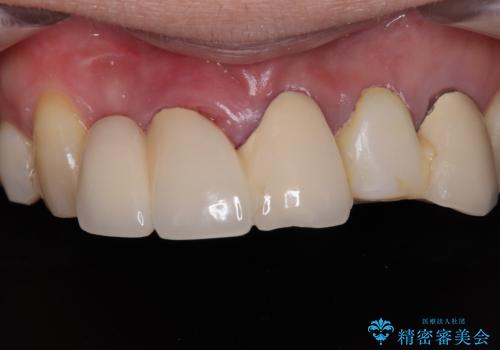 不具合の多い前歯 オールセラミックブリッジ治療の症例 治療前