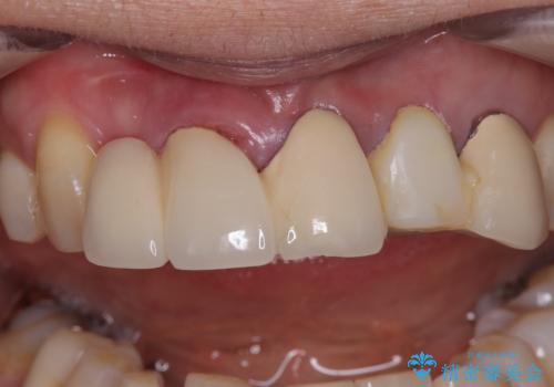 不具合の多い前歯 オールセラミックブリッジ治療の治療前